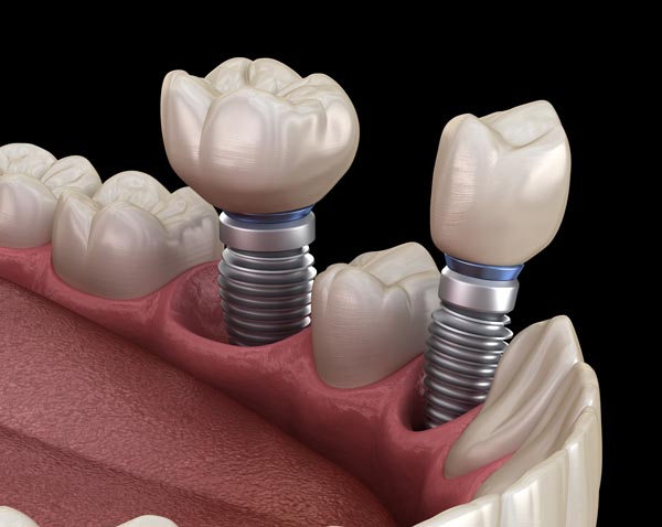 Basal Implants