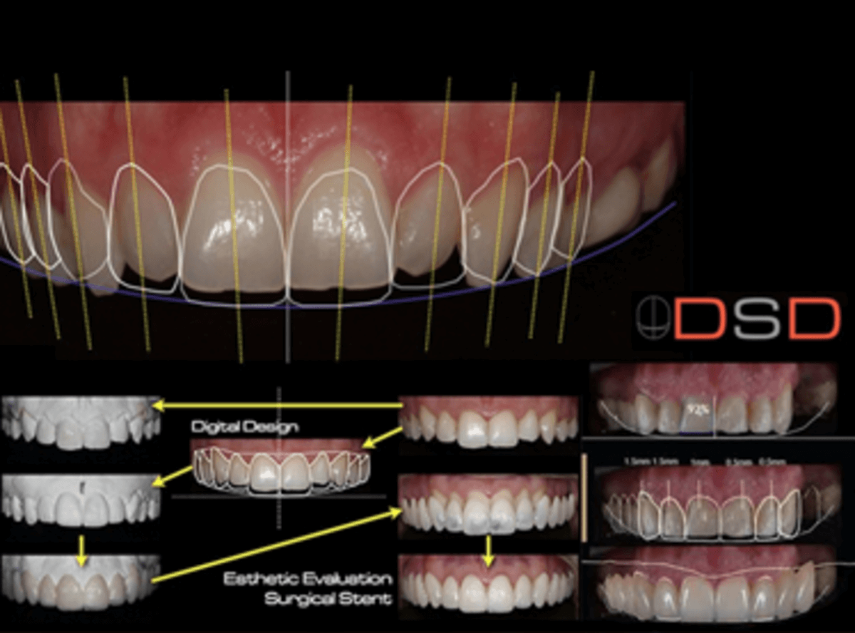 Digital Smile Designing