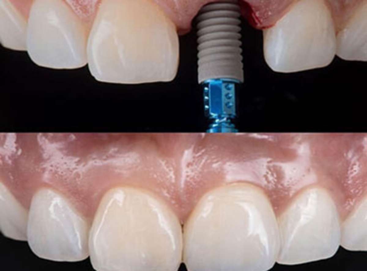 Single Tooth Implants