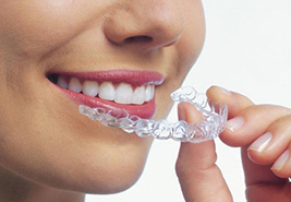 Dental Aligners