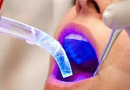 Best Dental Implants Treatment